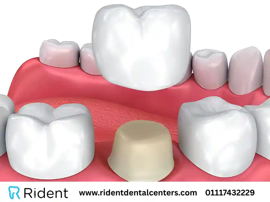 نظام الاكل بعد تركيب الطربوش.. الأطباء يحذرون من المأكولات الصلبة